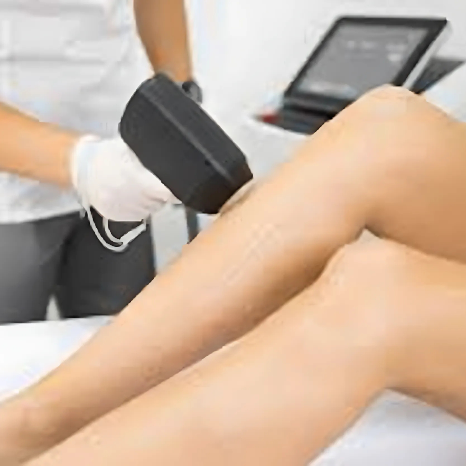 Depilación con láser de diodo